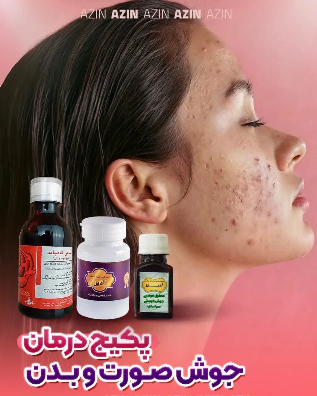 🍃پکیج درمان جوش صورت و بدن آذین